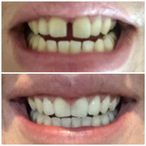 smile direct club bad results.